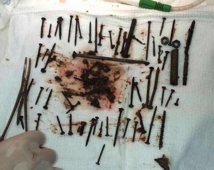 Хирурги вынули 150 металлических предметов из желудка жительницы Бурятии