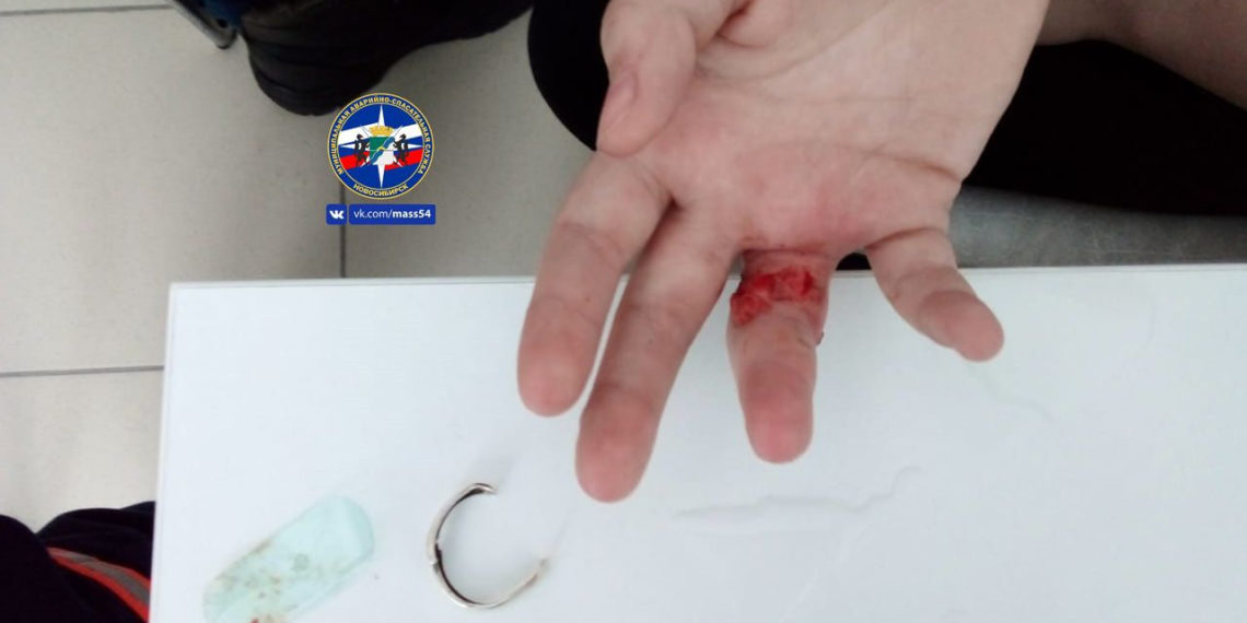 Кольцо порвало кожу на пальце 10-летней школьницы