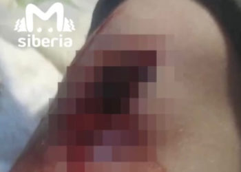 Новосибирский школьник остался без перевязки — все медсестры ушли в отпуск