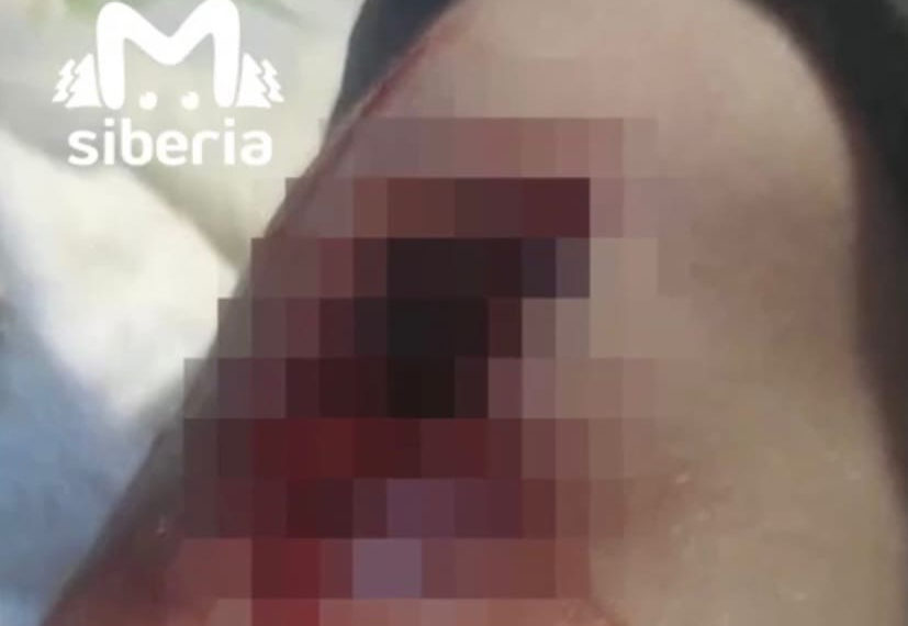 Новосибирский школьник остался без перевязки — все медсестры ушли в отпуск