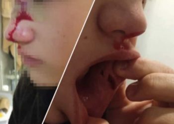 Подкараулили и напали толпой: новосибирец обвинил детей мигрантов в избиении 14-летнего сына