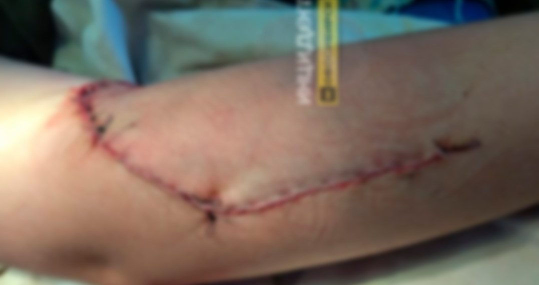 Маленькая школьница из Кыштовки порвала себе руку во время перемены