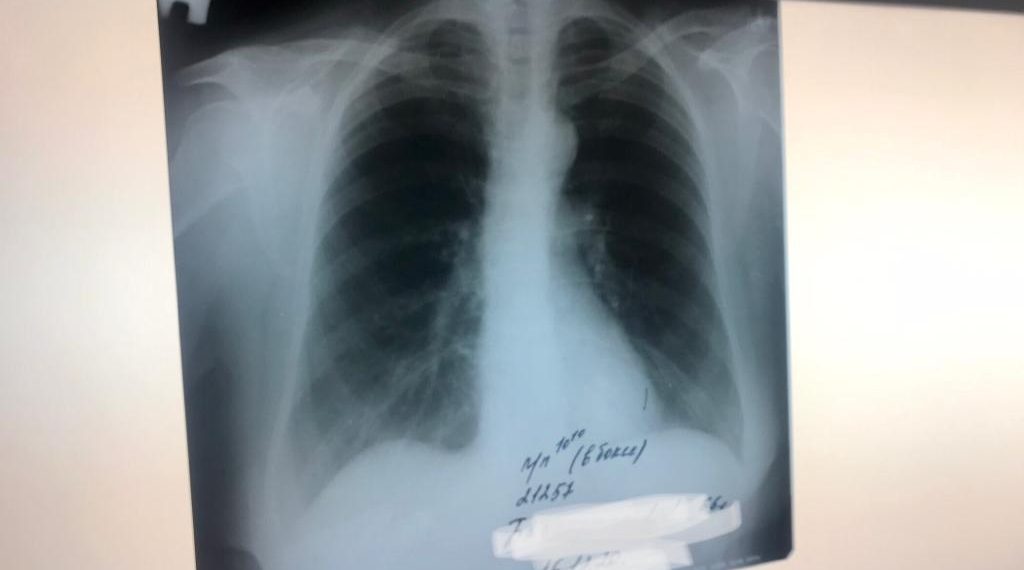 В Новосибирской области снизилась заболеваемость туберкулезом