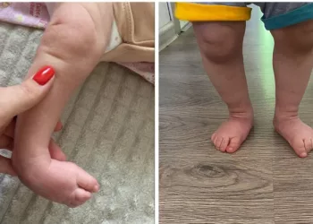 Мальчика с врожденной тяжелой деформацией стоп вылечили новосибирские врачи