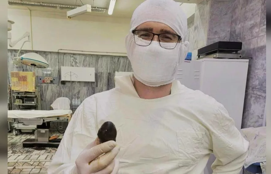 Врачи извлекли из тела сибирячки камень размером с куриное яйцо