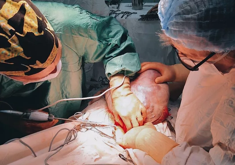 Ученые вырезали у сибирячки опухоль размером с ребенка