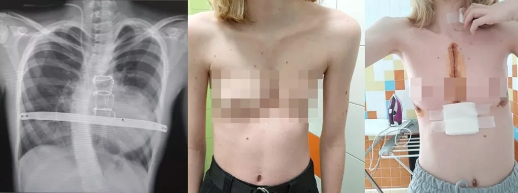 Сложную операцию провели 17-летней жительнице Новосибирска с деформацией груди