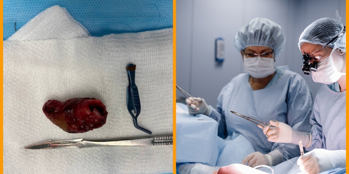 «Любил сидеть нога на ногу»: новосибирские хирурги вырезали мужчине тромб размером с грецкий орех