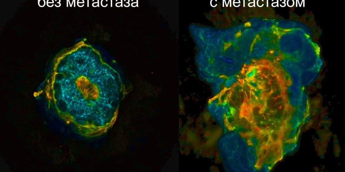 Российские ученые разработали ускорение диагностики лимфоузлов при раке молочной железы