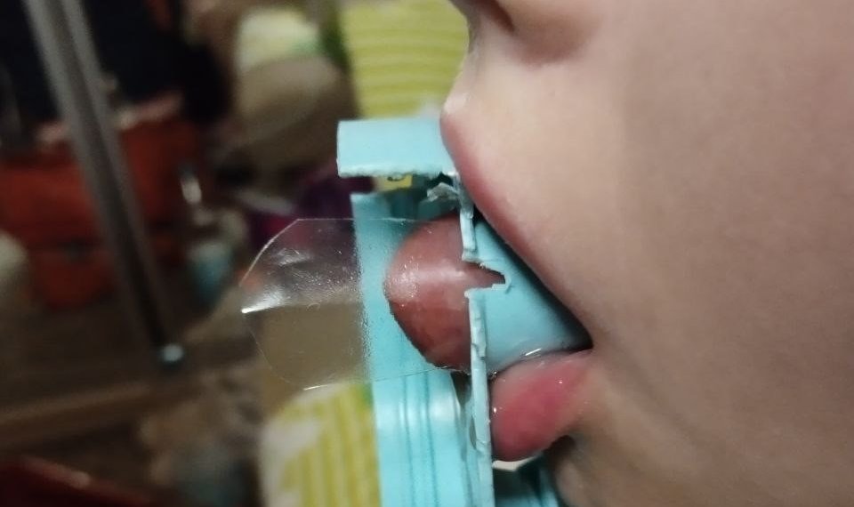 Язык застрял в крышке у девочки из Новосибирска