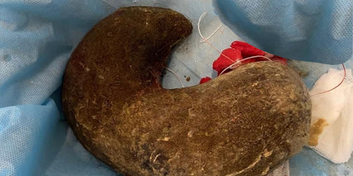 Двухкилограммовый ком волос вытащили из желудка новосибирской студентки