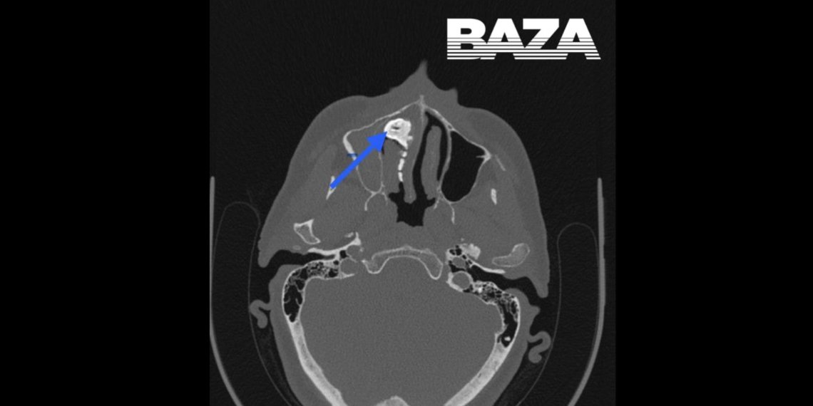 Россиянка несколько лет жила с орехом в носу
