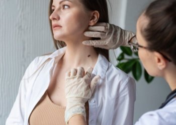 Врач рассказала, как определить раковую родинку