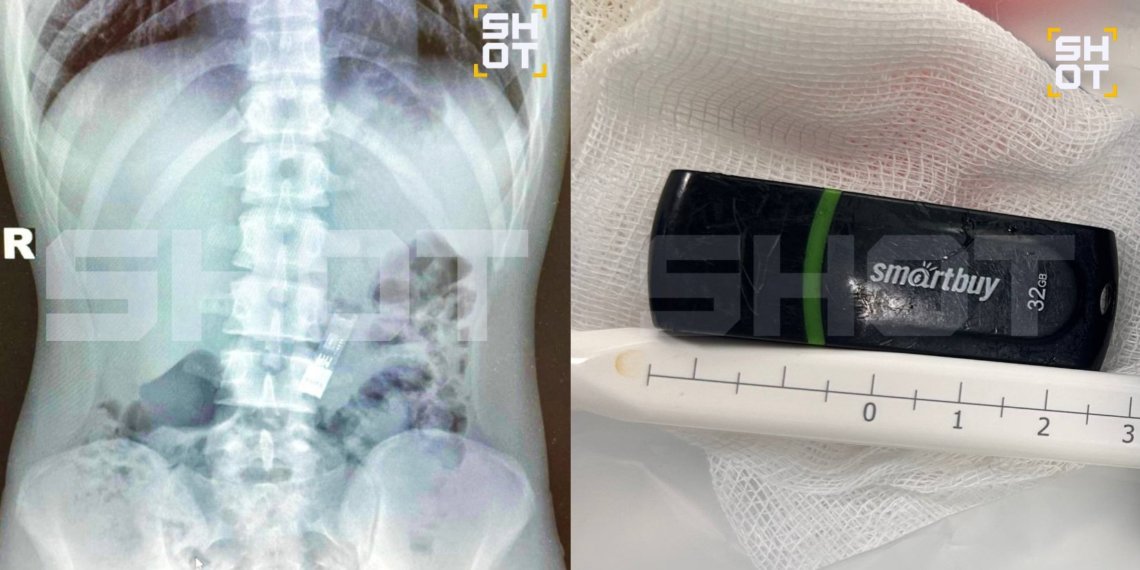 Российский школьник проглотил флешку с домашним заданием