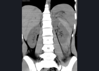 В Новосибирске у девочки разорвалась почка из-за удара на тренировке