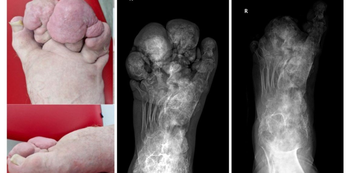 Новосибирские врачи взялись спасать сибиряка с редчайшим врожденным заболеванием