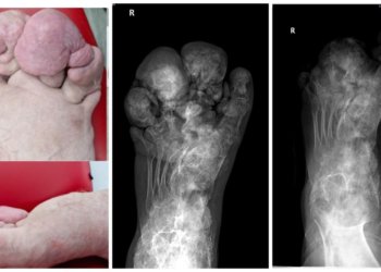Новосибирские врачи взялись спасать сибиряка с редчайшим врожденным заболеванием