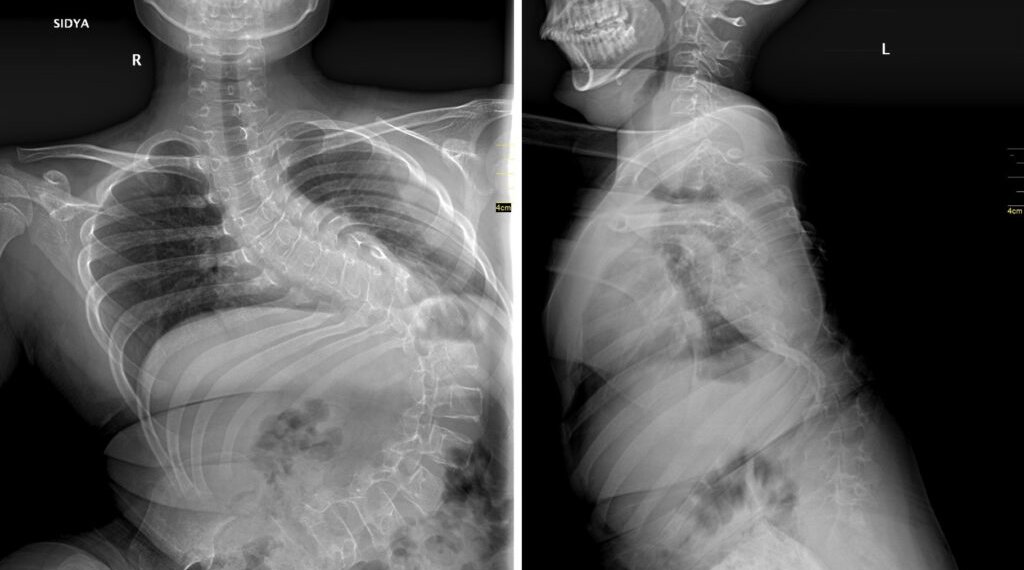 Мальчика с тяжелейшим сколиозом прооперировали новосибирские врачи