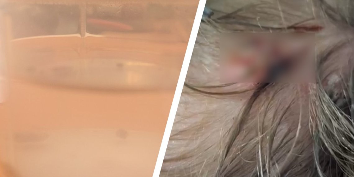 Врачи удалили восемь личинок овечьего овода из головы ребенка в Новосибирске