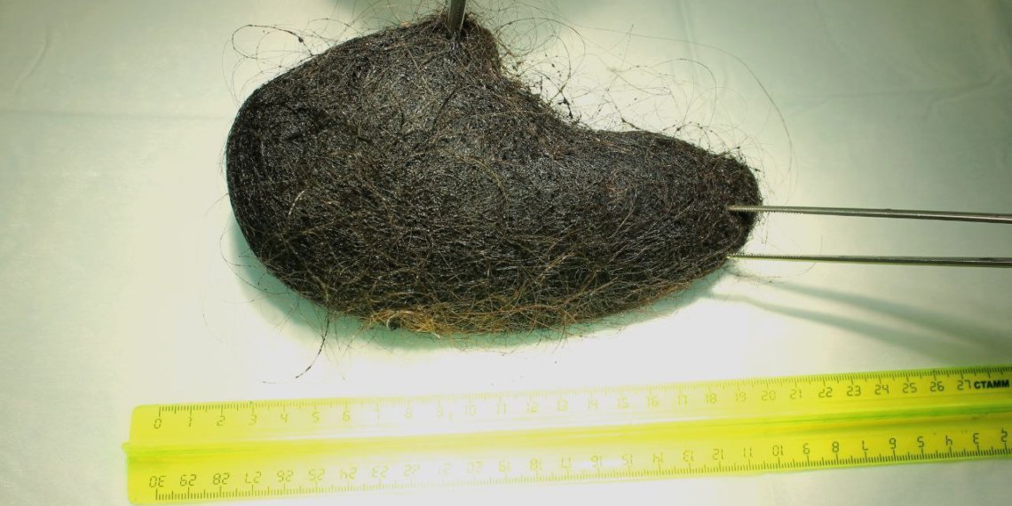 Комок волос в желудке: хирурги спасли девочку с редким синдромом Рапунцель