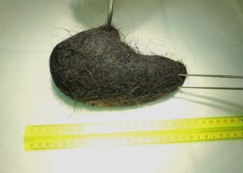 Комок волос в желудке: хирурги спасли девочку с редким синдромом Рапунцель