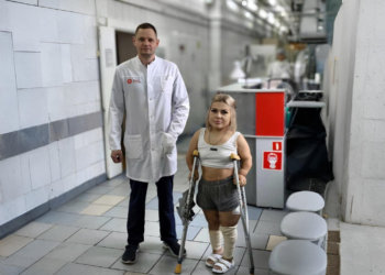 Новосибирские хирурги помогли пациентке с разной длиной ног с помощью эндопротеза