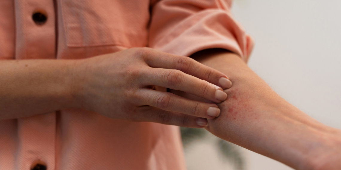 Как снять лихорадочный синдром при укусе насекомого?