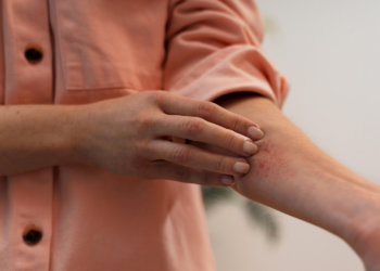 Как снять лихорадочный синдром при укусе насекомого?