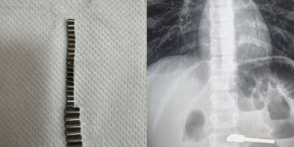 Хирурги извлекли 25 магнитиков из кишечника ребёнка в Новосибирске