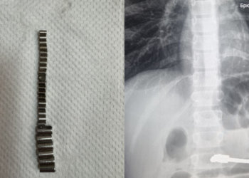 Хирурги извлекли 25 магнитиков из кишечника ребёнка в Новосибирске