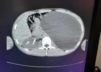 Врачи спасли 17-летнего новосибирца, у которого почка выросла до размеров пятилитровой бутылки