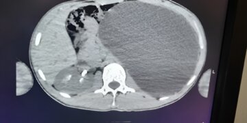 Врачи спасли 17-летнего новосибирца, у которого почка выросла до размеров пятилитровой бутылки