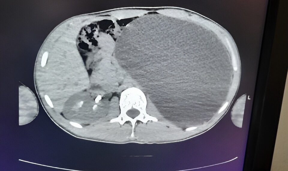 Врачи спасли 17-летнего новосибирца, у которого почка выросла до размеров пятилитровой бутылки