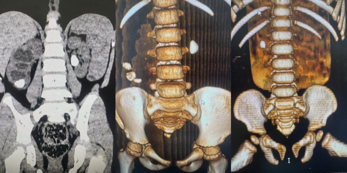 В Новосибирске выросло число детей с диагнозом мочекаменная болезнь