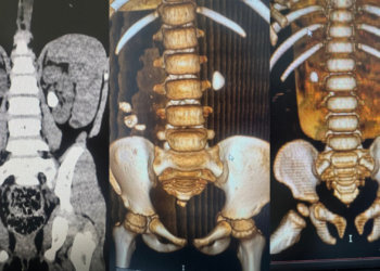В Новосибирске выросло число детей с диагнозом мочекаменная болезнь
