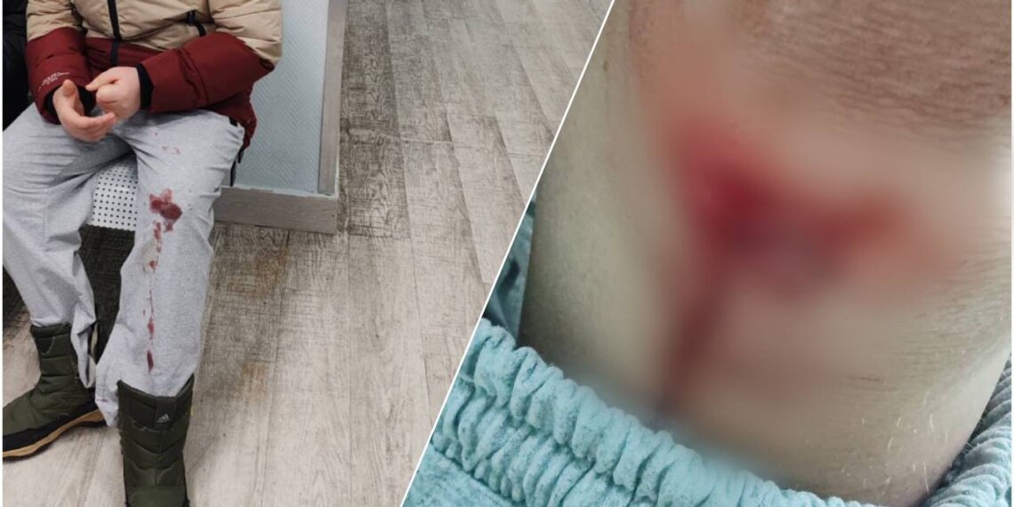 В Новосибирске ребёнок получил рваную рану, упав около подъезда