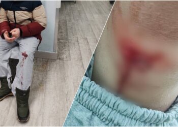 В Новосибирске ребёнок получил рваную рану, упав около подъезда