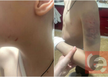 «Боится выходить на улицу»: на новосибирского школьника напала собака