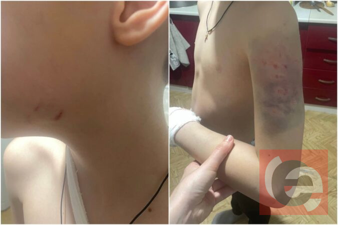 «Боится выходить на улицу»: на новосибирского школьника напала собака