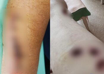 В Новосибирске семья год не может добиться наказания для нападавших
