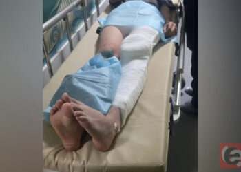 14-летний питбайкер сломал ногу после драки с двумя новосибирцами