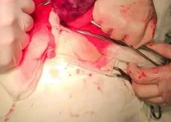 «Это был не аппендицит»: в Новосибирске 9-летней девочке удалили яичник с опухолью величиной с кулак
